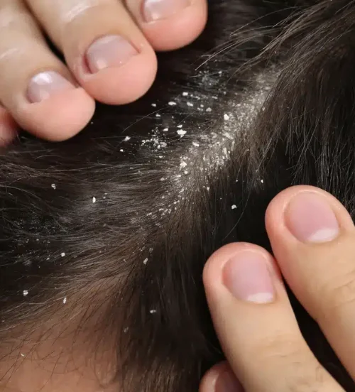 Dandruff