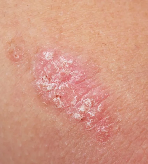 Psoriasis